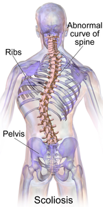 Nutrition and Diet for Scoliosis