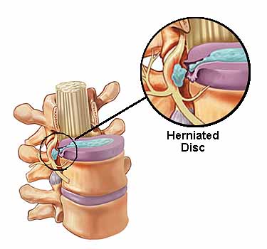 Disc Injuries -Thoracic Disc Herniation and Chiropractors